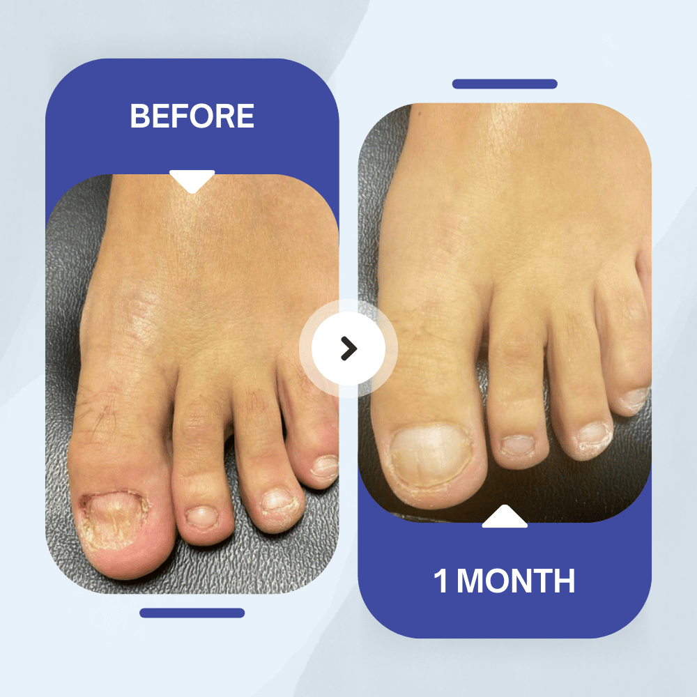 HealNail™ Light Pro